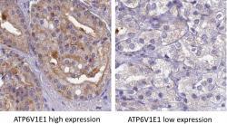 ATP6V1E1 gene high and low fig 2.jpg